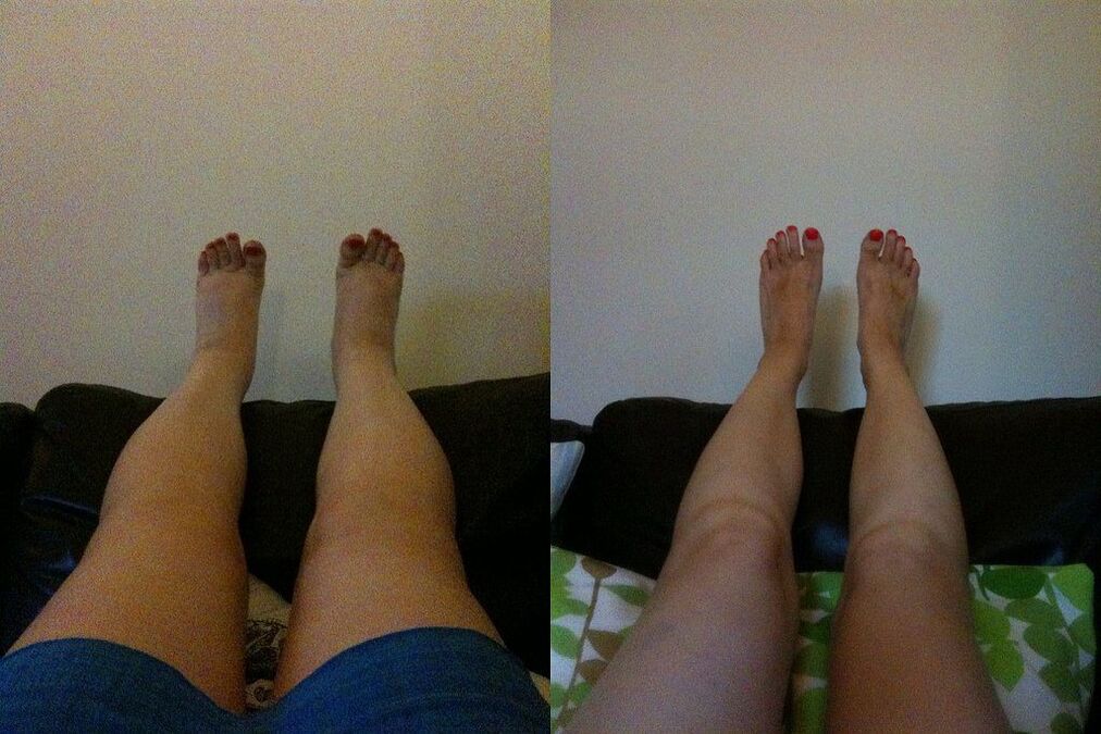 Effective result before and after applying the Ostelife Premium Plus cream from Margarita