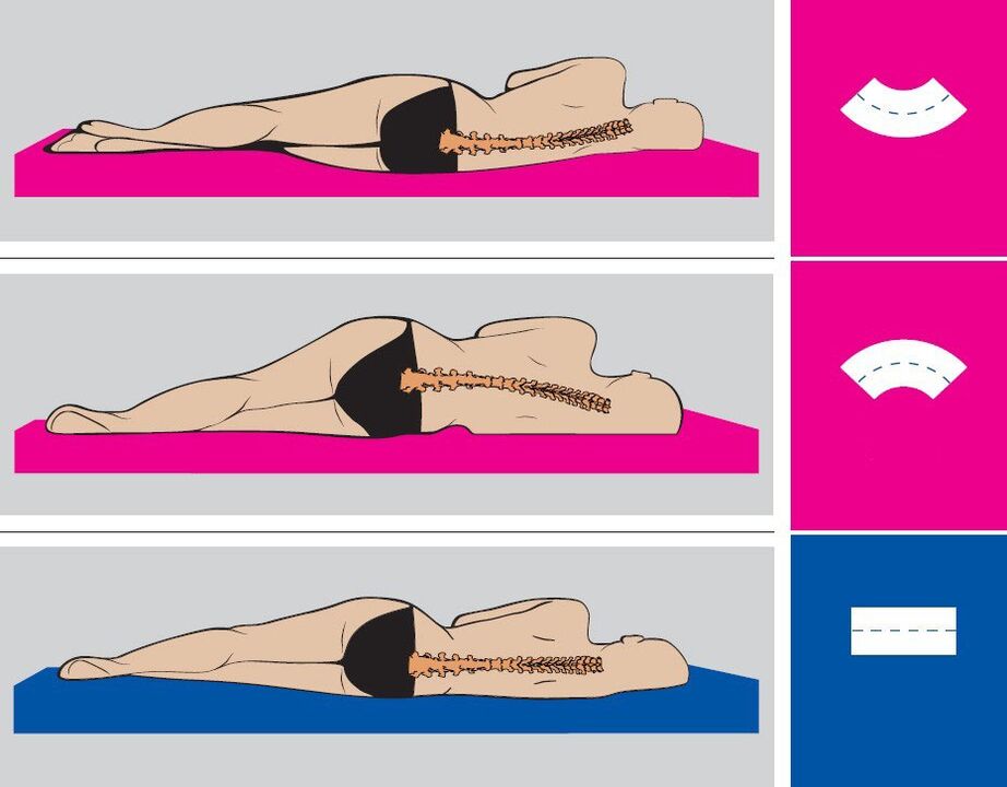 Correct posture during sleep for lumbar osteochondrosis