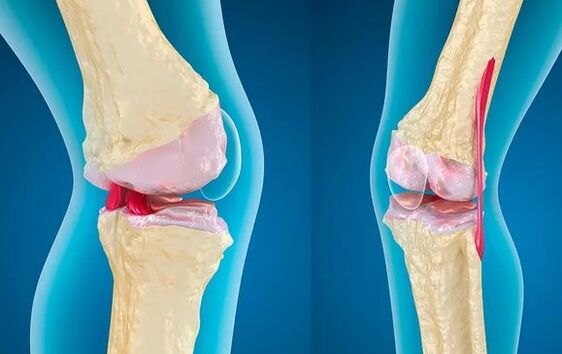 Gonarthrosis of the 3rd degree of the knee joint