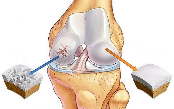 Norm and deviation to the arthrosis of the knee joint