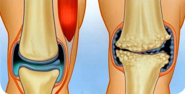 The normal condition of the joint and the causes of the development of the arthrosis of the knee