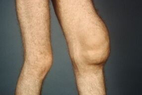 The causes and symptoms of osteoarthritis of the knee joint