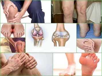 How to prevent the development of arthritis and arthrosis
