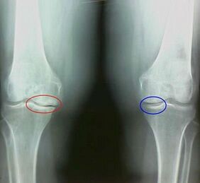 The result of the treatment of arthritis and arthrosis