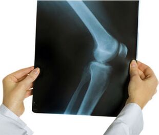 X-ray image of osteoarthritis of the knee joint