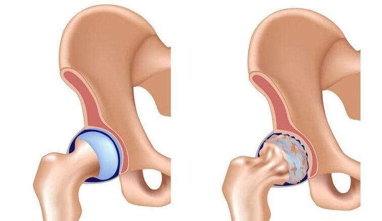 Healthy and together with osteoarthritis